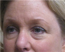 Eyelid Surgery Before Photo by Meegan Gruber, MD; Tampa, FL - Case 23899