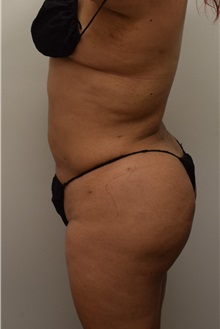 Buttock Lift with Augmentation After Photo by Meegan Gruber, MD; Tampa, FL - Case 29921