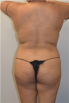 Buttock Lift with Augmentation Before Photo by Meegan Gruber, MD; Tampa, FL - Case 29921