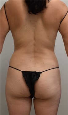 Buttock Lift with Augmentation Before Photo by Meegan Gruber, MD; Tampa, FL - Case 29922