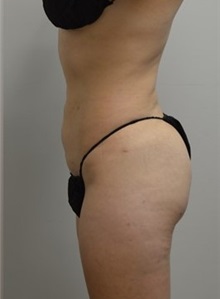 Buttock Lift with Augmentation After Photo by Meegan Gruber, MD; Tampa, FL - Case 29922