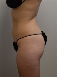 Buttock Lift with Augmentation Before Photo by Meegan Gruber, MD; Tampa, FL - Case 29922