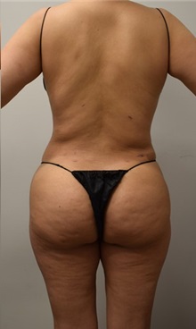 Buttock Lift with Augmentation After Photo by Meegan Gruber, MD; Tampa, FL - Case 29923