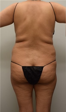 Buttock Lift with Augmentation Before Photo by Meegan Gruber, MD; Tampa, FL - Case 29923