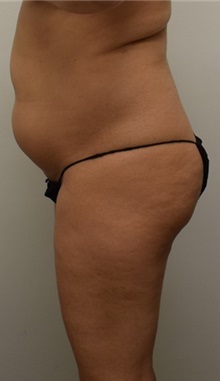 Buttock Lift with Augmentation Before Photo by Meegan Gruber, MD; Tampa, FL - Case 29923