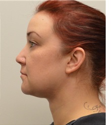 Liposuction After Photo by Meegan Gruber, MD; Tampa, FL - Case 29925