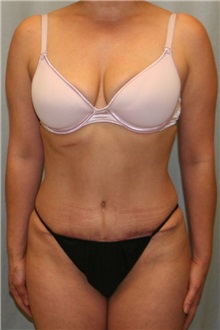 Tummy Tuck After Photo by Meegan Gruber, MD; Tampa, FL - Case 8859