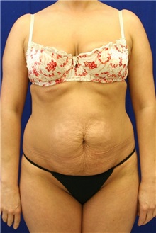 Tummy Tuck Before Photo by Meegan Gruber, MD; Tampa, FL - Case 8859