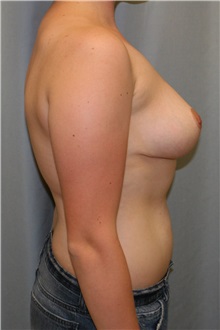 Breast Reduction After Photo by Meegan Gruber, MD; Tampa, FL - Case 8891