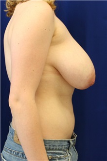 Breast Reduction Before Photo by Meegan Gruber, MD; Tampa, FL - Case 8891