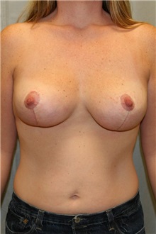 Breast Lift After Photo by Meegan Gruber, MD; Tampa, FL - Case 8892