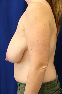 Breast Lift Before Photo by Meegan Gruber, MD; Tampa, FL - Case 8892