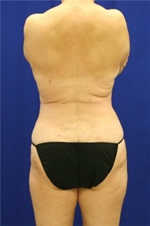 Liposuction After Photo by Meegan Gruber, MD; Tampa, FL - Case 8893