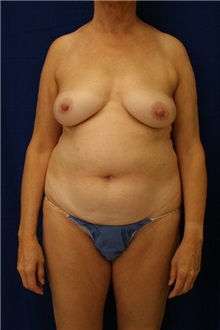 Liposuction Before Photo by Meegan Gruber, MD; Tampa, FL - Case 8893