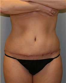Tummy Tuck After Photo by Meegan Gruber, MD; Tampa, FL - Case 8894