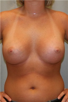Breast Augmentation After Photo by Meegan Gruber, MD; Tampa, FL - Case 8895