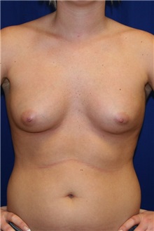 Breast Augmentation Before Photo by Meegan Gruber, MD; Tampa, FL - Case 8895
