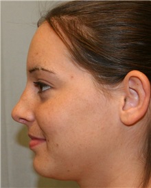 Rhinoplasty After Photo by Meegan Gruber, MD; Tampa, FL - Case 8896