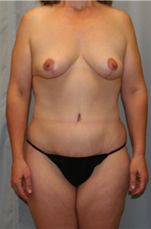 Body Contouring After Photo by Meegan Gruber, MD; Lakewood Ranch, FL - Case 8898