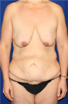 Body Contouring Before Photo by Meegan Gruber, MD; Lakewood Ranch, FL - Case 8898