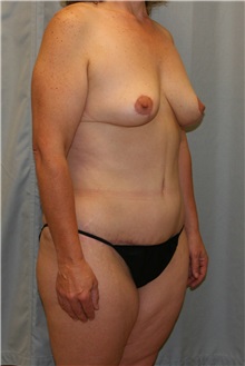 Body Contouring After Photo by Meegan Gruber, MD; Lakewood Ranch, FL - Case 8898