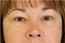 Eyelid Surgery After Photo by Meegan Gruber, MD; Tampa, FL - Case 8903