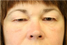 Eyelid Surgery Before Photo by Meegan Gruber, MD; Tampa, FL - Case 8903