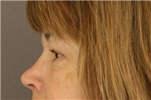 Eyelid Surgery After Photo by Meegan Gruber, MD; Lakewood Ranch, FL - Case 8903