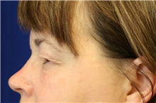 Eyelid Surgery Before Photo by Meegan Gruber, MD; Lakewood Ranch, FL - Case 8903