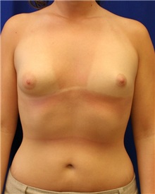 Breast Augmentation Before Photo by Meegan Gruber, MD; Tampa, FL - Case 8908