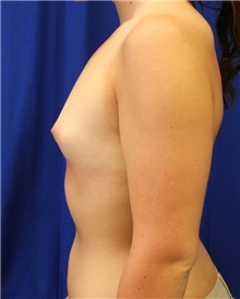 Breast Augmentation Before Photo by Meegan Gruber, MD; Tampa, FL - Case 8908