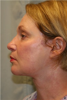 Facelift After Photo by Meegan Gruber, MD; Tampa, FL - Case 8929