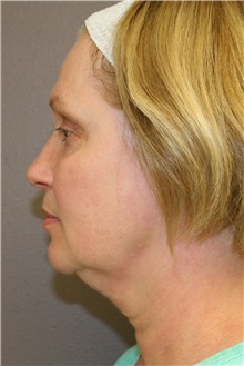 Facelift Before Photo by Meegan Gruber, MD; Tampa, FL - Case 8929