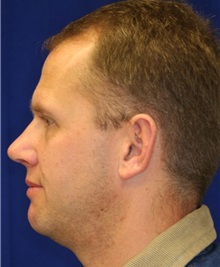 Rhinoplasty After Photo by Meegan Gruber, MD; Tampa, FL - Case 8943