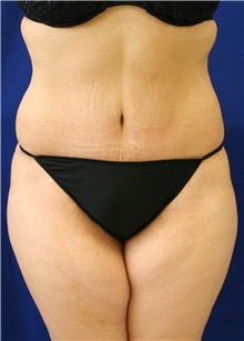 Tummy Tuck After Photo by Meegan Gruber, MD; Tampa, FL - Case 8999