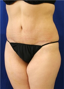 Tummy Tuck After Photo by Meegan Gruber, MD; Tampa, FL - Case 8999