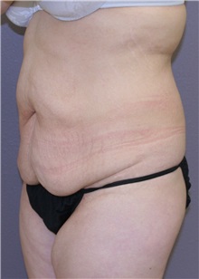 Tummy Tuck Before Photo by Meegan Gruber, MD; Tampa, FL - Case 8999