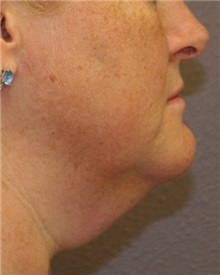 Liposuction Before Photo by Meegan Gruber, MD; Tampa, FL - Case 9001