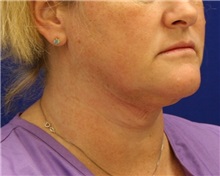 Liposuction After Photo by Meegan Gruber, MD; Tampa, FL - Case 9001