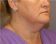 Liposuction Before Photo by Meegan Gruber, MD; Tampa, FL - Case 9001