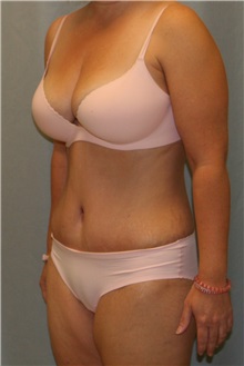 Tummy Tuck After Photo by Meegan Gruber, MD; Tampa, FL - Case 9007