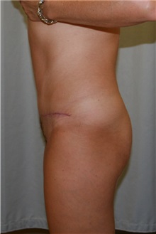 Tummy Tuck After Photo by Meegan Gruber, MD; Tampa, FL - Case 9488