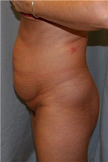 Tummy Tuck Before Photo by Meegan Gruber, MD; Tampa, FL - Case 9488