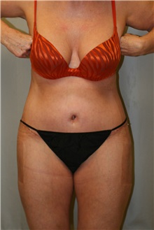 Liposuction After Photo by Meegan Gruber, MD; Tampa, FL - Case 9489