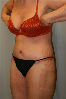 Liposuction After Photo by Meegan Gruber, MD; Tampa, FL - Case 9489