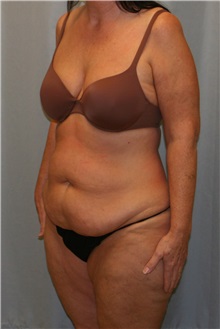 Liposuction Before Photo by Meegan Gruber, MD; Tampa, FL - Case 9489
