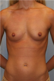 Breast Augmentation Before Photo by Meegan Gruber, MD; Tampa, FL - Case 9490
