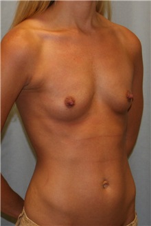 Breast Augmentation Before Photo by Meegan Gruber, MD; Lakewood Ranch, FL - Case 9490