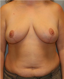 Breast Reduction After Photo by Meegan Gruber, MD; Tampa, FL - Case 9494