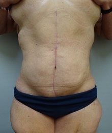 Panniculectomy After Photo by Owen Reid, MD; Vancouver, BC - Case 47952